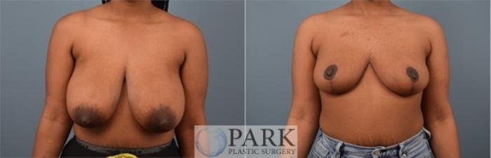 Before & After Breast Reduction Case 51 Front View in Rocky Mount, NC
