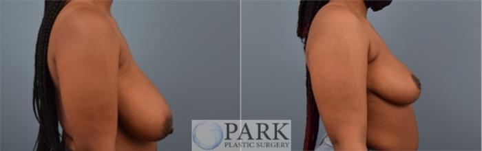 Before & After Breast Reduction Case 51 Right Side View in Rocky Mount, NC