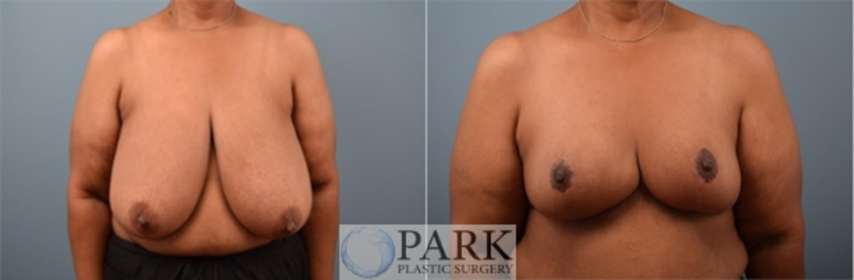 Before & After Breast Reduction Case 62 Front View in Rocky Mount, NC