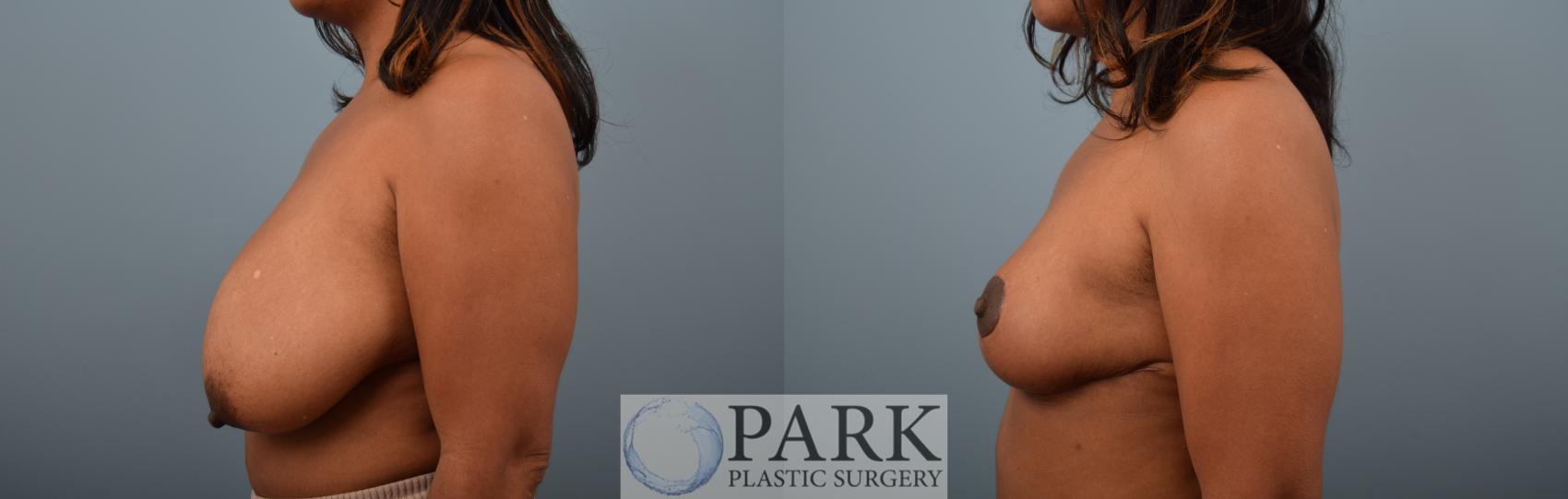 Insurance Approved Breast Reduction