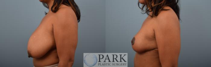 Insurance Approved Breast Reduction