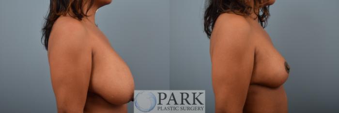 Insurance Approved Breast Reduction