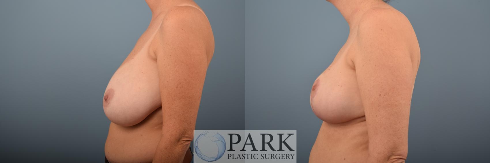 Before & After Breast Reduction Case 68 Left Side View in Rocky Mount & Greenville, NC