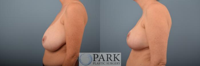 Before & After Breast Reduction Case 68 Left Side View in Rocky Mount & Greenville, NC