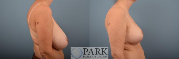 Before & After Breast Reduction Case 68 Right Side View in Rocky Mount & Greenville, NC