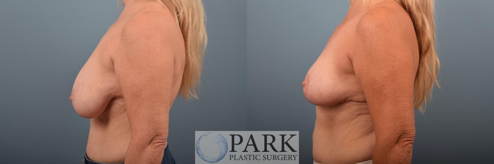 Before & After Breast Reduction Case 73 Left Side View in Rocky Mount & Greenville, NC