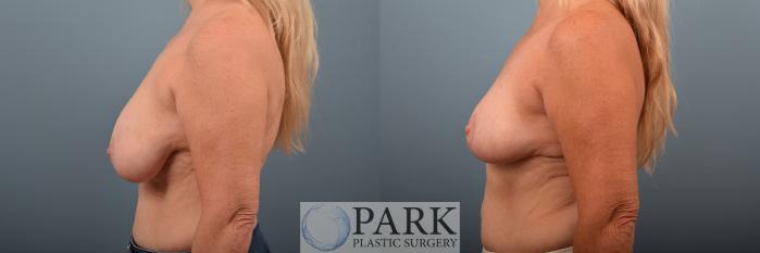 Before & After Breast Reduction Case 73 Left Side View in Rocky Mount & Greenville, NC