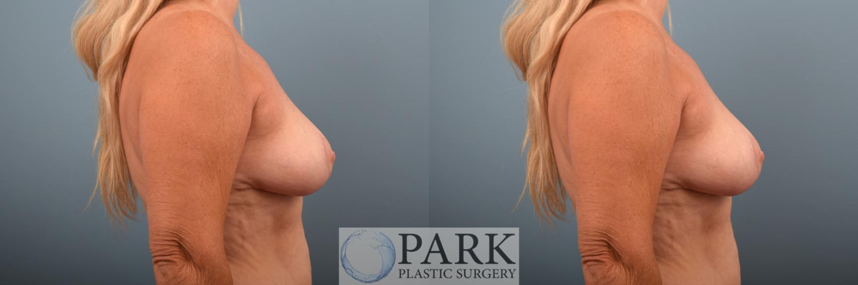 Before & After Breast Reduction Case 73 Right Side View in Rocky Mount & Greenville, NC