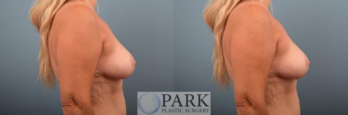 Before & After Breast Reduction Case 73 Right Side View in Rocky Mount & Greenville, NC
