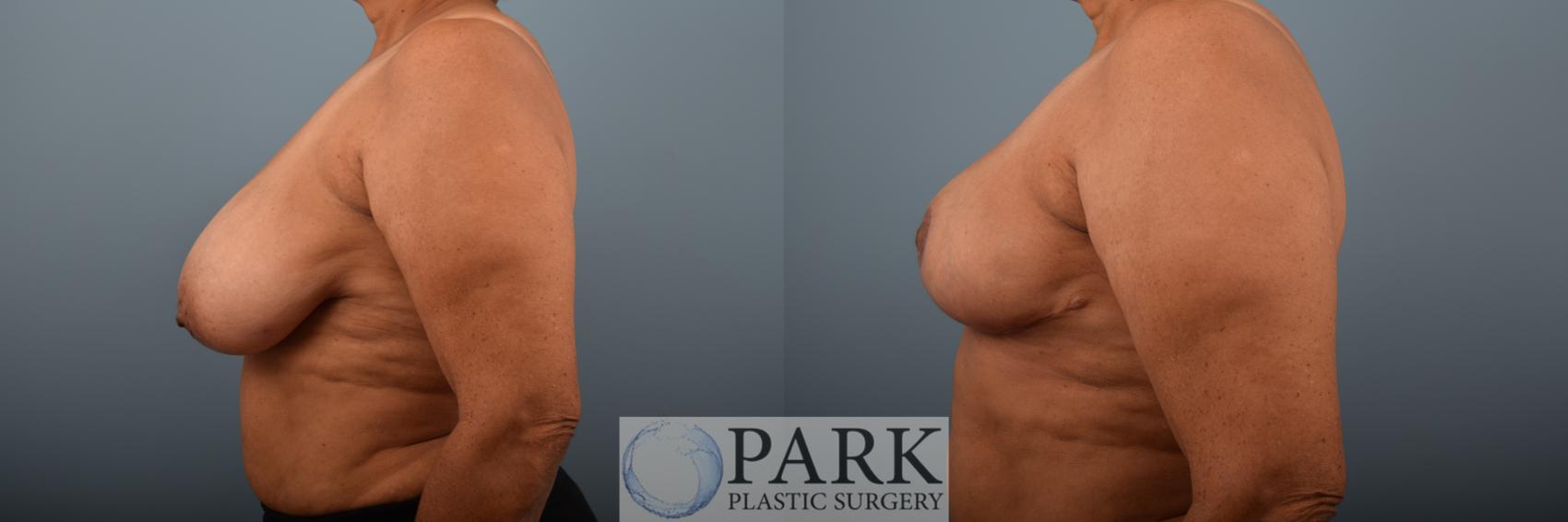 Before & After Breast Reduction Case 79 Left Side View in Rocky Mount & Greenville, NC