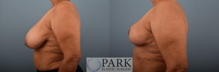 Before & After Breast Reduction Case 79 Left Side View in Rocky Mount & Greenville, NC