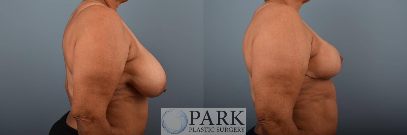 Before & After Breast Reduction Case 79 Right Side View in Rocky Mount & Greenville, NC