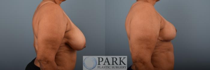 Before & After Breast Reduction Case 79 Right Side View in Rocky Mount & Greenville, NC