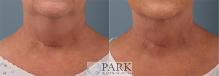 Before & After Liposuction Case 61 Front View in Rocky Mount, NC