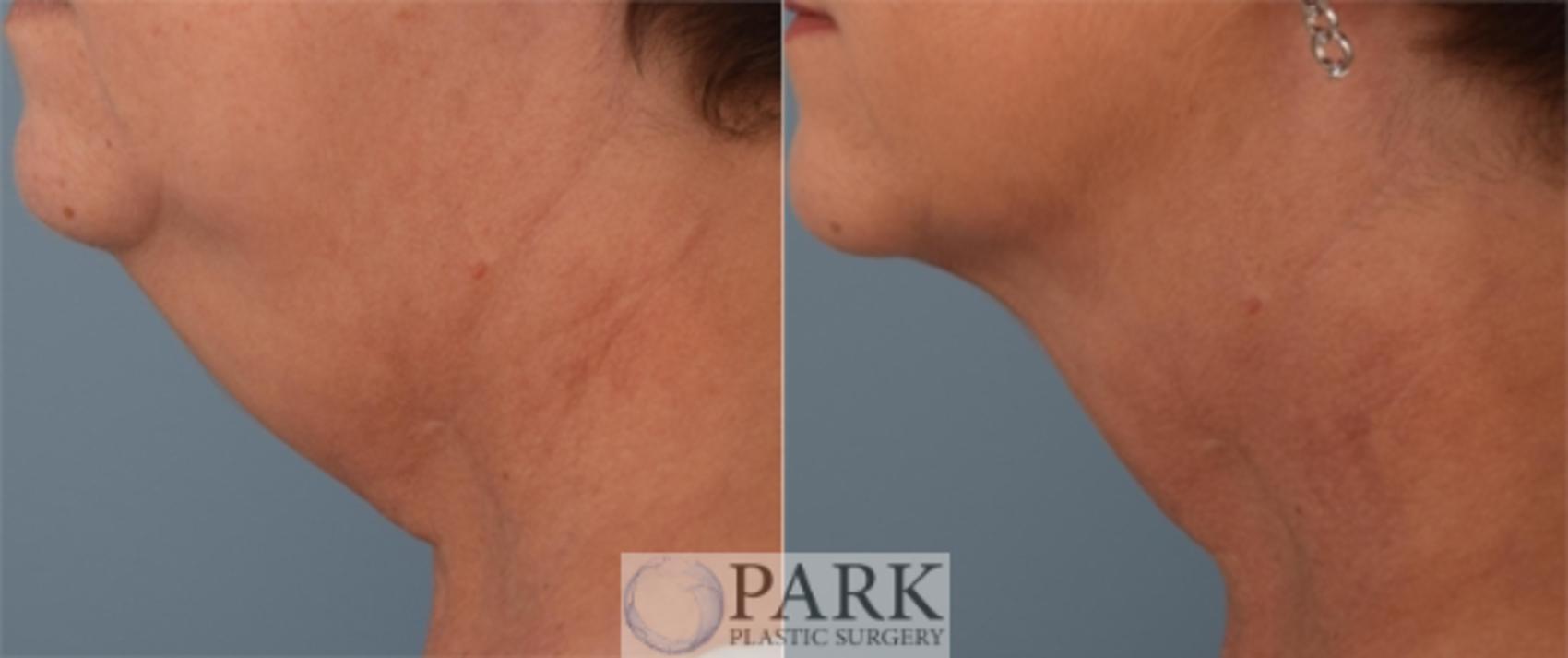 Before & After Chin/Neck Liposuction Case 61 Left Side View in Rocky Mount & Greenville, NC