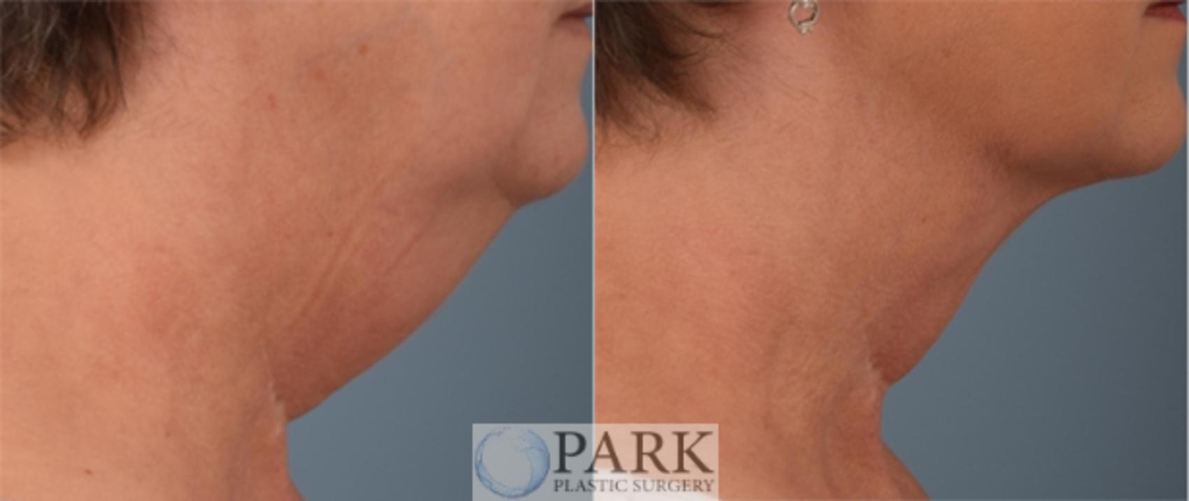 Before & After Chin/Neck Liposuction Case 61 Right Side View in Rocky Mount & Greenville, NC