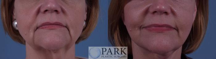 Before & After Facelift Case 23 Front View in Rocky Mount, NC