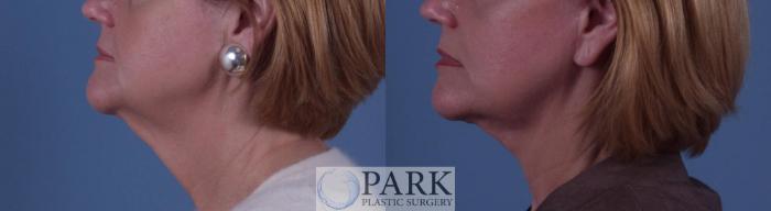 Before & After Facelift Case 23 Left Side View in Rocky Mount, NC