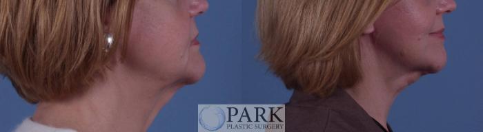 Before & After Facelift Case 23 Right Side View in Rocky Mount, NC