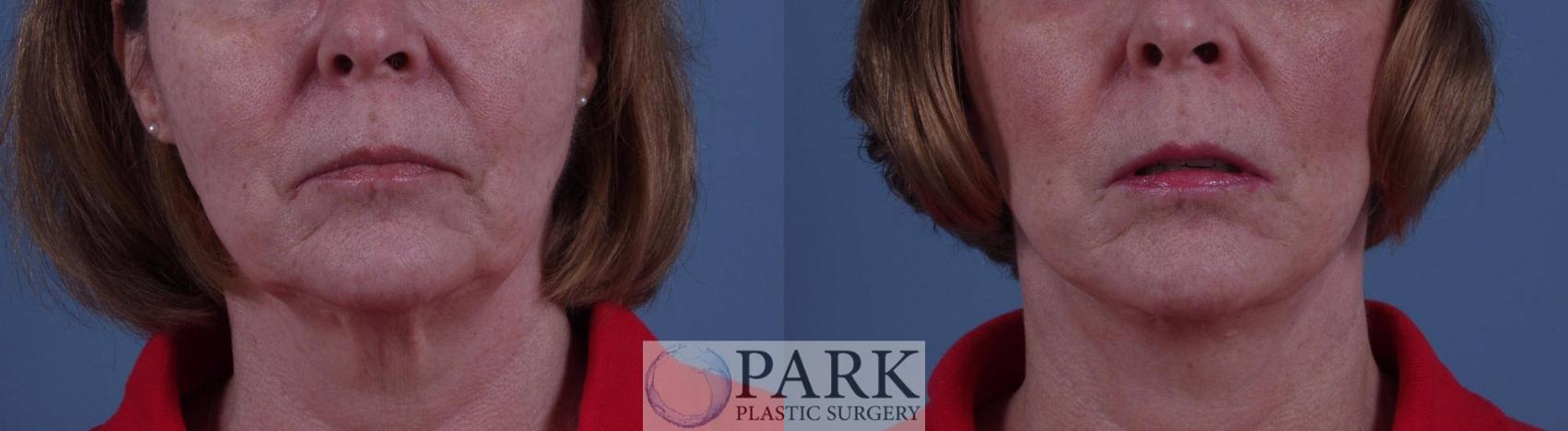 Before & After Facelift Case 24 Front View in Rocky Mount, NC