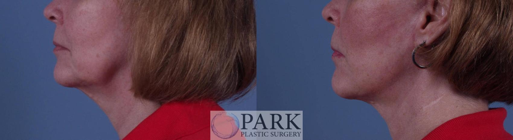 Before & After Facelift Case 24 Left Side View in Rocky Mount & Greenville, NC