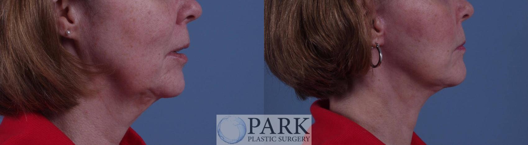 Before & After Facelift Case 24 Right Side View in Rocky Mount & Greenville, NC
