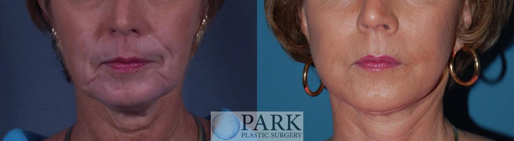 Before & After Facelift Case 25 Front View in Rocky Mount, NC