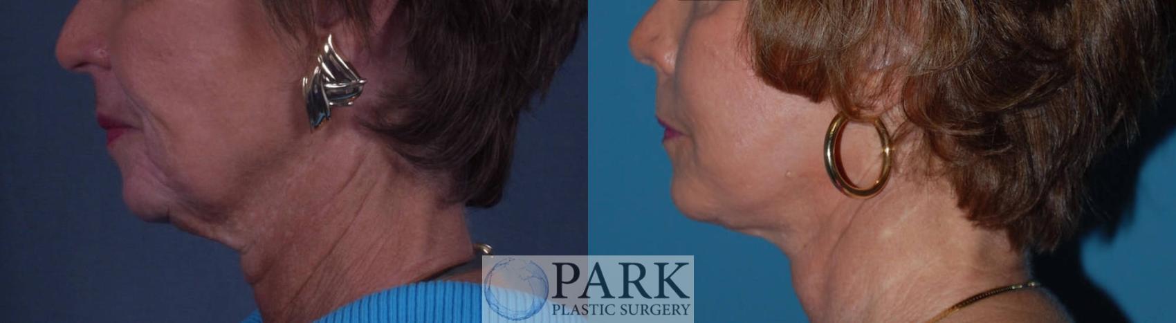 Before & After Facelift Case 25 Left Side View in Rocky Mount & Greenville, NC