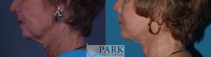 Before & After Facelift Case 25 Left Side View in Rocky Mount, NC