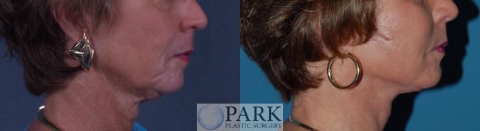 Before & After Facelift Case 25 Right Side View in Rocky Mount, NC
