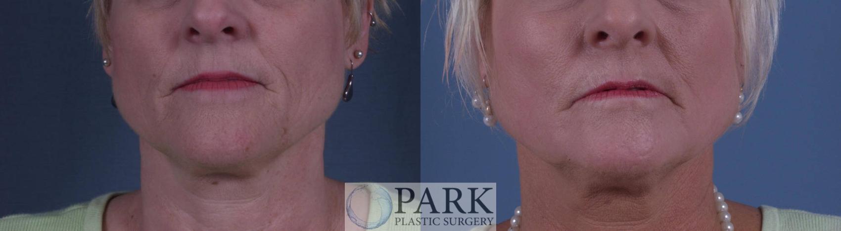 Before & After Laser Skin Resurfacing Case 10 Front View in Rocky Mount, NC