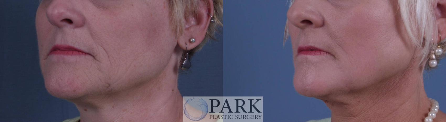 Before & After Laser Skin Resurfacing Case 10 Left Oblique View in Rocky Mount & Greenville, NC
