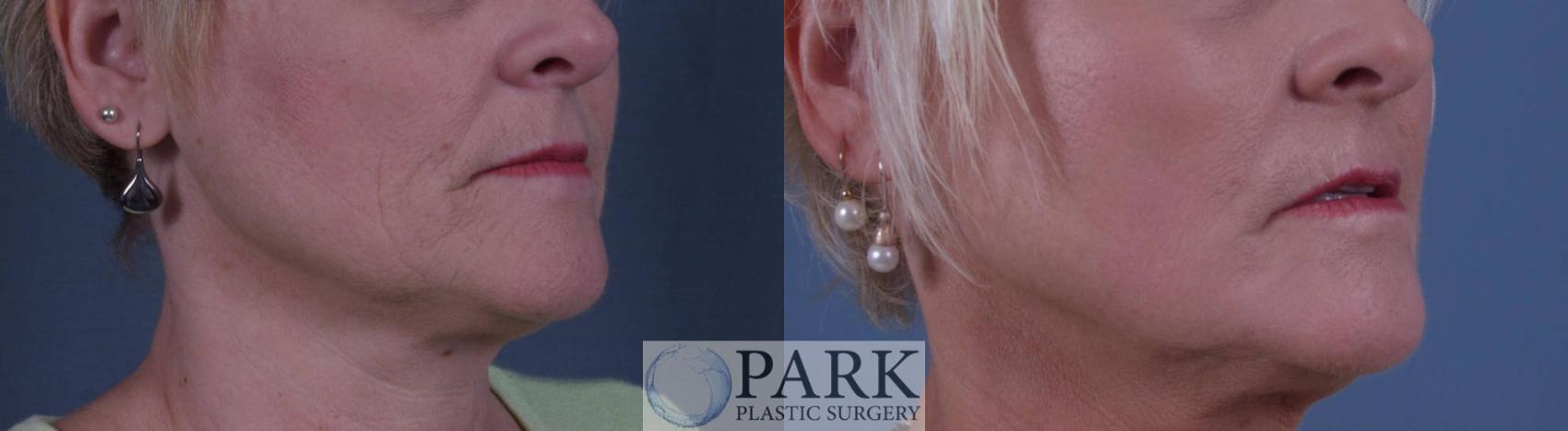 Before & After Laser Skin Resurfacing Case 10 Right Oblique View in Rocky Mount & Greenville, NC