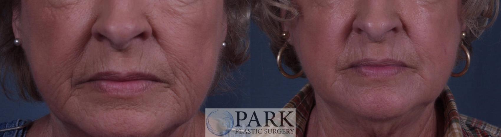 Before & After Laser Skin Resurfacing Case 11 Front View in Rocky Mount, NC
