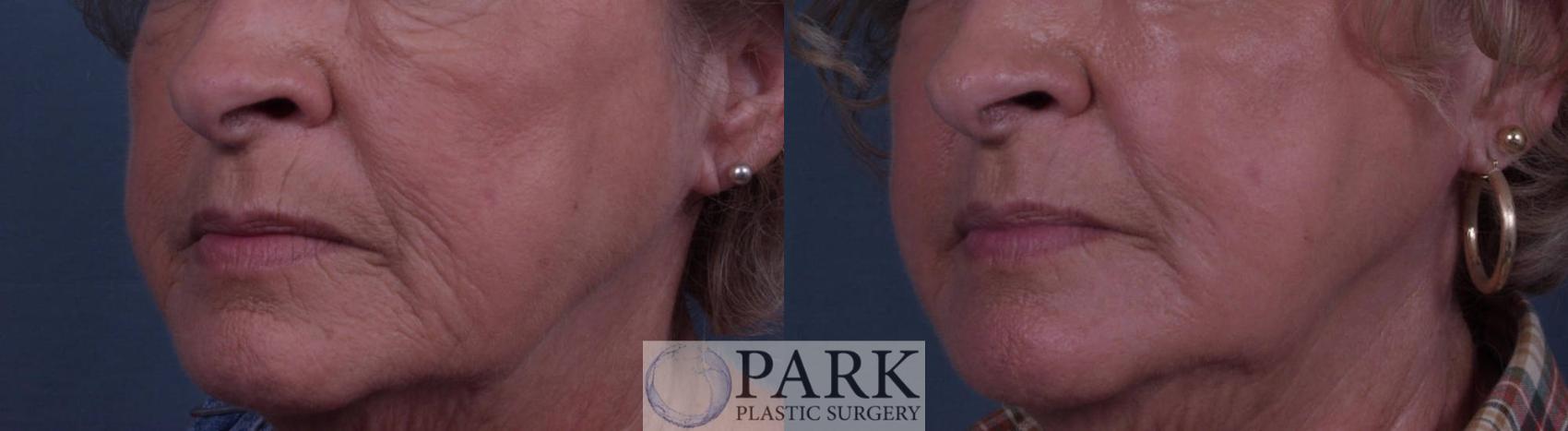 Before & After Laser Skin Resurfacing Case 11 Left Oblique View in Rocky Mount & Greenville, NC