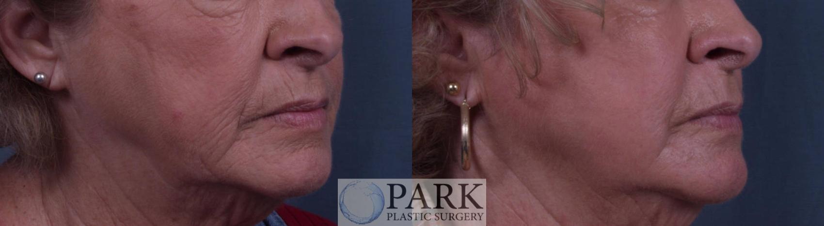 Before & After Laser Skin Resurfacing Case 11 Right Oblique View in Rocky Mount & Greenville, NC
