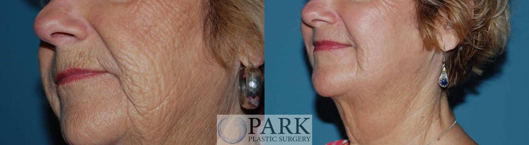 Before & After Laser Skin Resurfacing Case 12 Left Oblique View in Rocky Mount & Greenville, NC