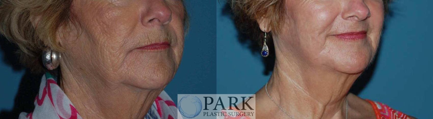 Before & After Laser Skin Resurfacing Case 12 Right Oblique View in Rocky Mount & Greenville, NC