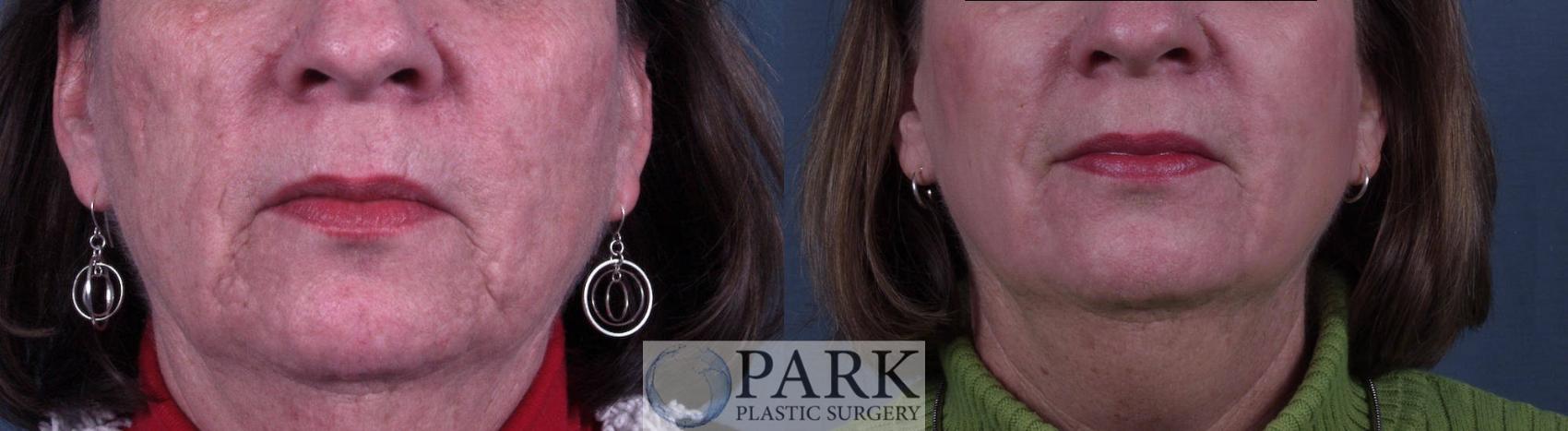 Before & After Laser Skin Resurfacing Case 13 Front View in Rocky Mount, NC