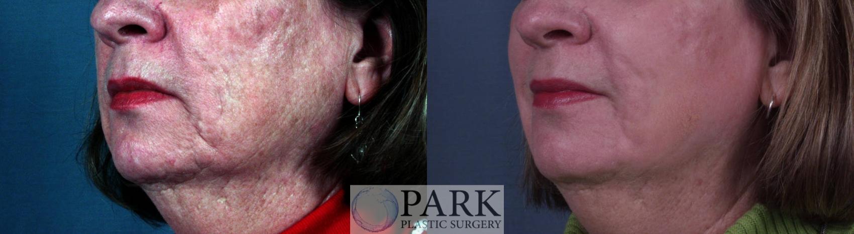 Before & After Laser Skin Resurfacing Case 13 Left Oblique View in Rocky Mount & Greenville, NC
