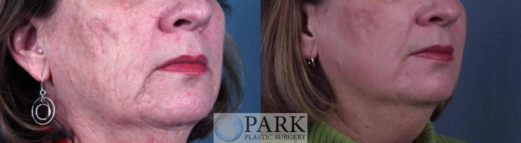 Before & After Laser Skin Resurfacing Case 13 Right Oblique View in Rocky Mount & Greenville, NC