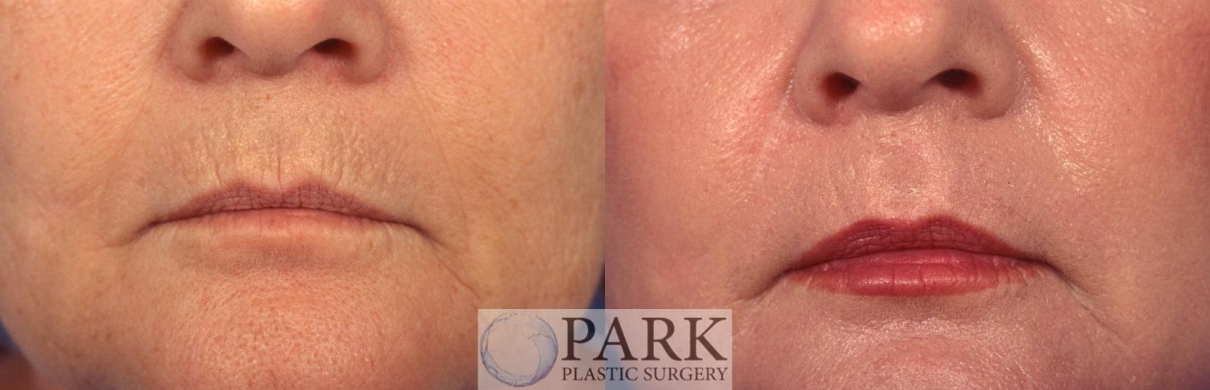 Before & After Laser Skin Resurfacing Case 14 Front Mouth View in Rocky Mount & Greenville, NC