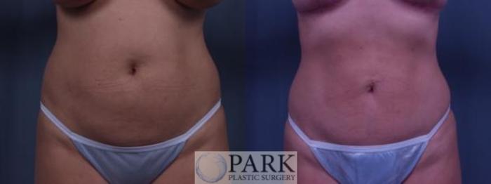 Before & After Liposuction Case 1 Front View in Rocky Mount, NC