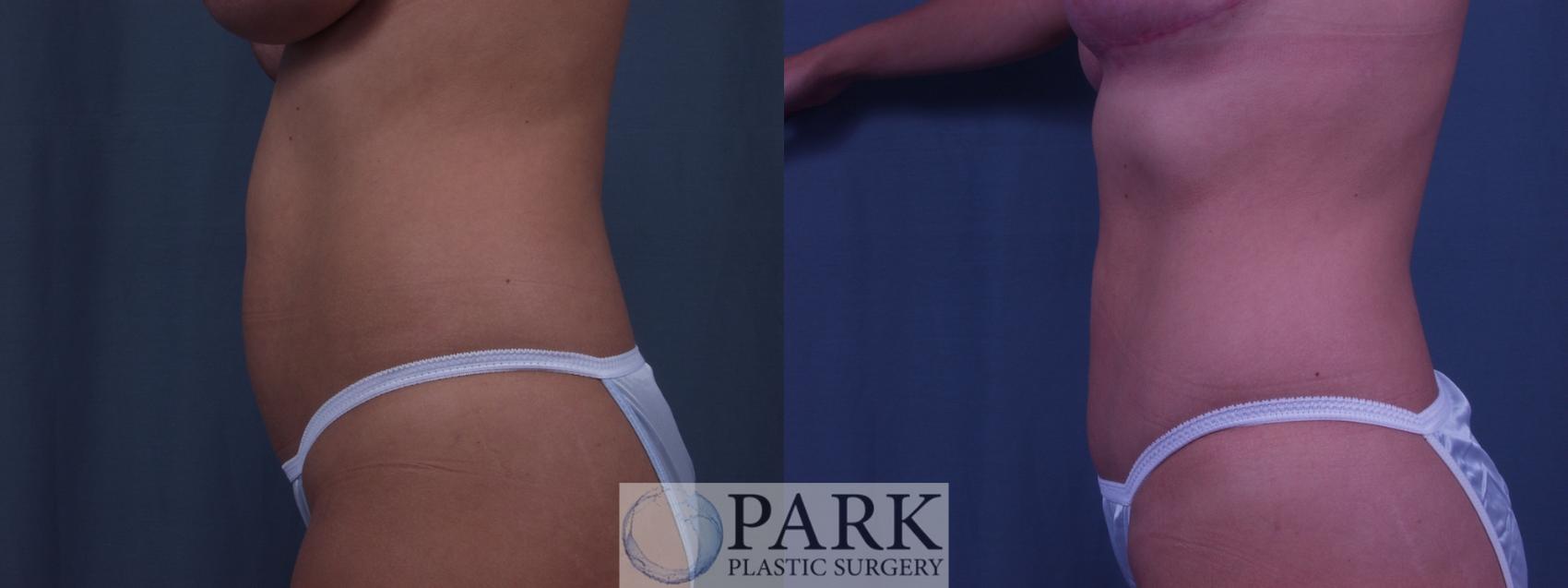 Before & After Liposuction Case 1 Left Side View in Rocky Mount & Greenville, NC