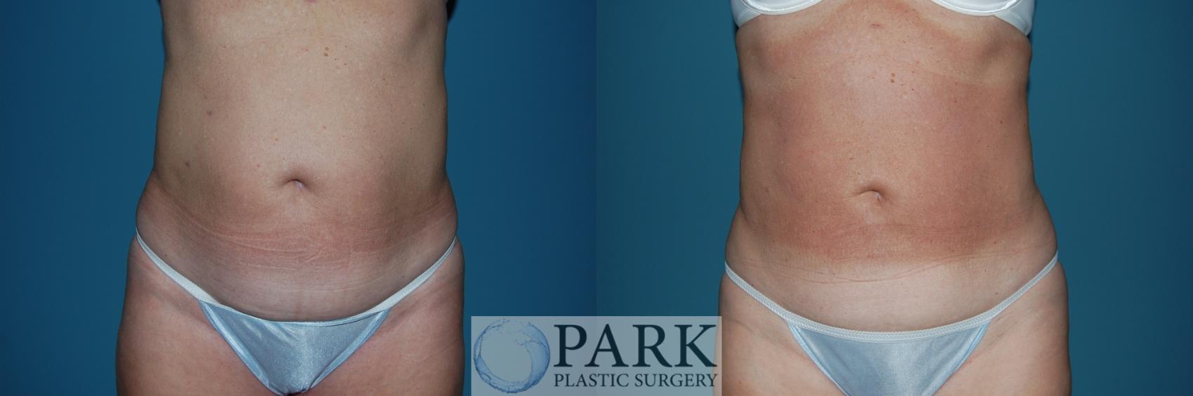 Before & After Liposuction Case 2 Front View in Rocky Mount, NC