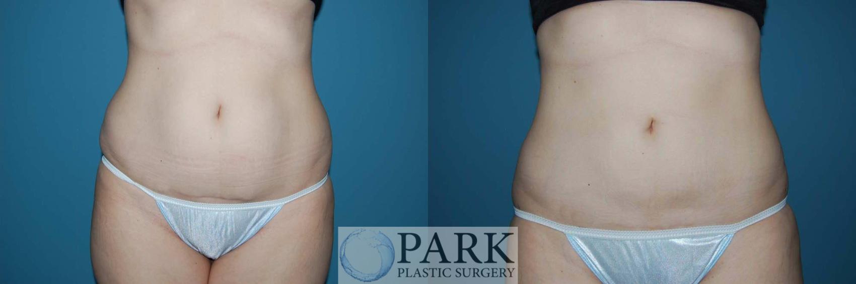 Before & After Liposuction Case 4 Front View in Rocky Mount & Greenville, NC