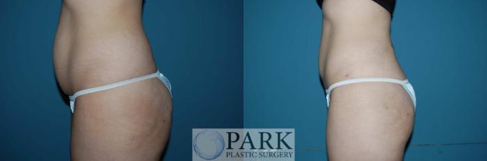 Before & After Liposuction Case 4 Left Side View in Rocky Mount & Greenville, NC