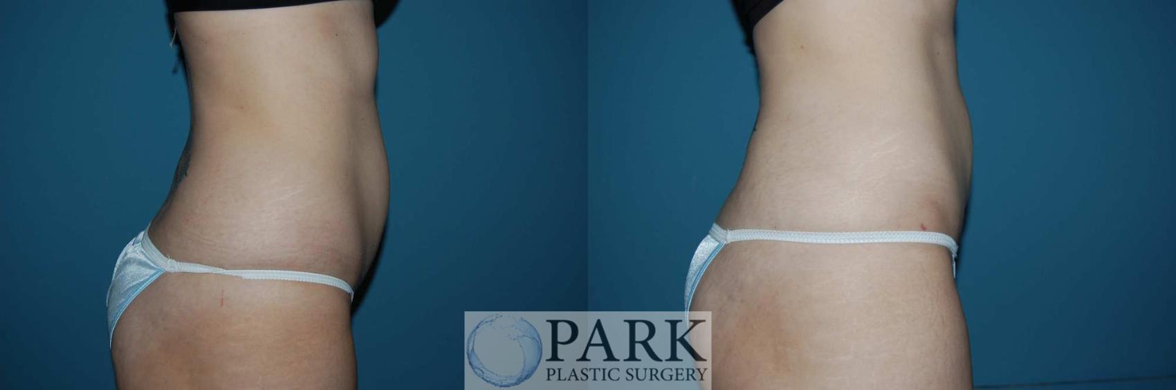 Before & After Liposuction Case 4 Right Side View in Rocky Mount & Greenville, NC