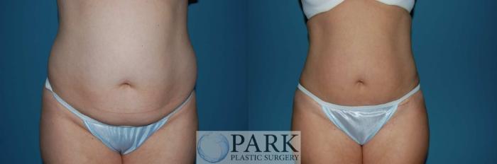Before & After Liposuction Case 5 Front View in Rocky Mount, NC