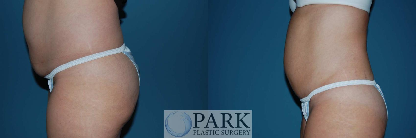 Before & After Liposuction Case 5 Left Side View in Rocky Mount & Greenville, NC